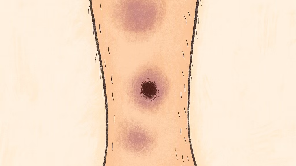 Kurz und kompakt: Das Warnsignal – Calciphylaxie