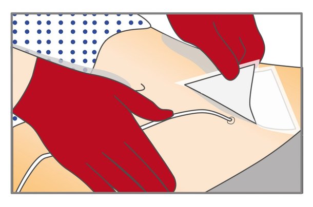 verbandwechsel-katheter-schritt-1