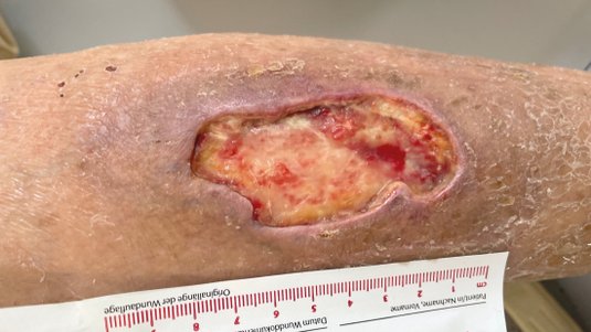Ulcus cruris venosum und Ulcus cruris arteriosum: Wissen Sie mehr!