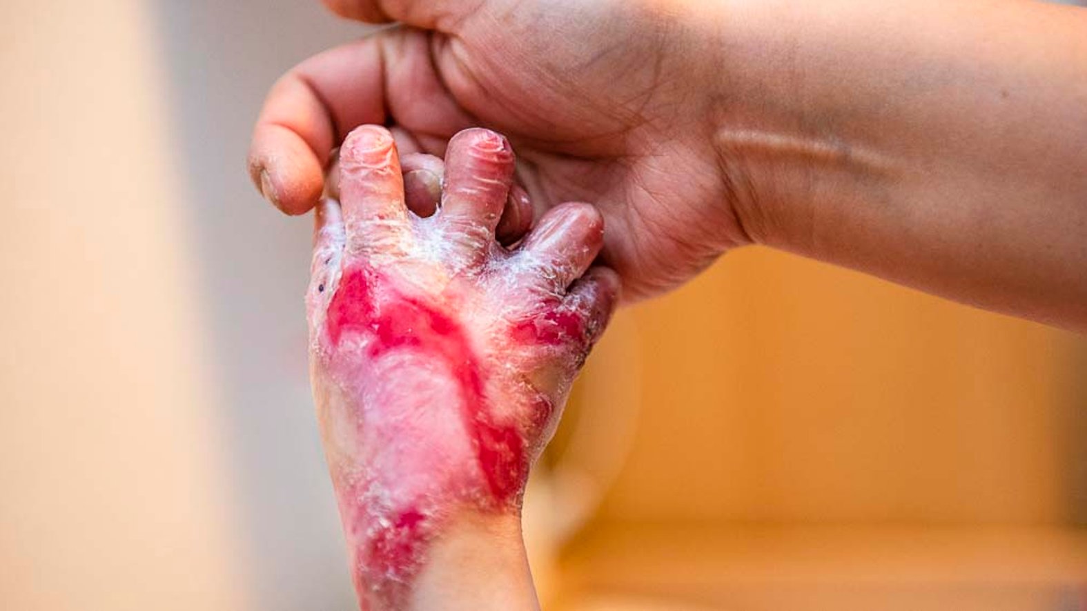 Hand mit Epidermolysis bullosa