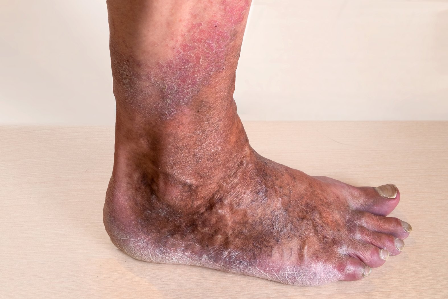 Stauungsdermatitis am Knöchel/Bein, Venenerkrankungen