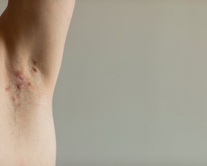 DEWU 2026: Bei einer Acne inversa zählt die frühe Diagnose
