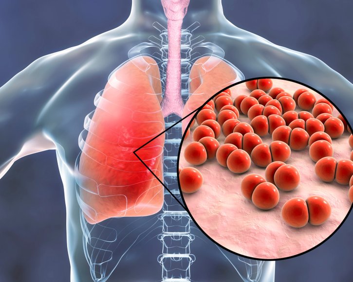 Neuer Pneumokokken-Impfstoff erweitert Schutzmöglichkeit für Erwachsene