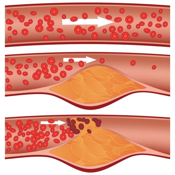 Stenose, Verstopfung einer Arterie