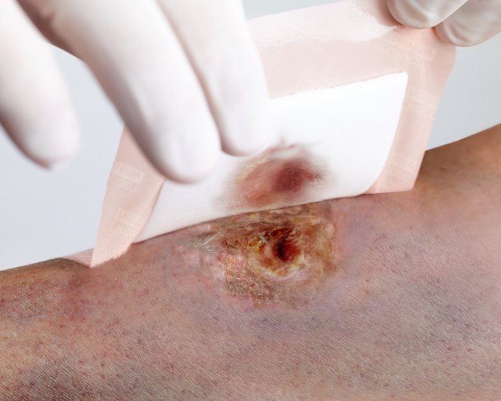 DracoFoam sensitiv wird von empfindlicher Wundumgebungshaut abgezogen