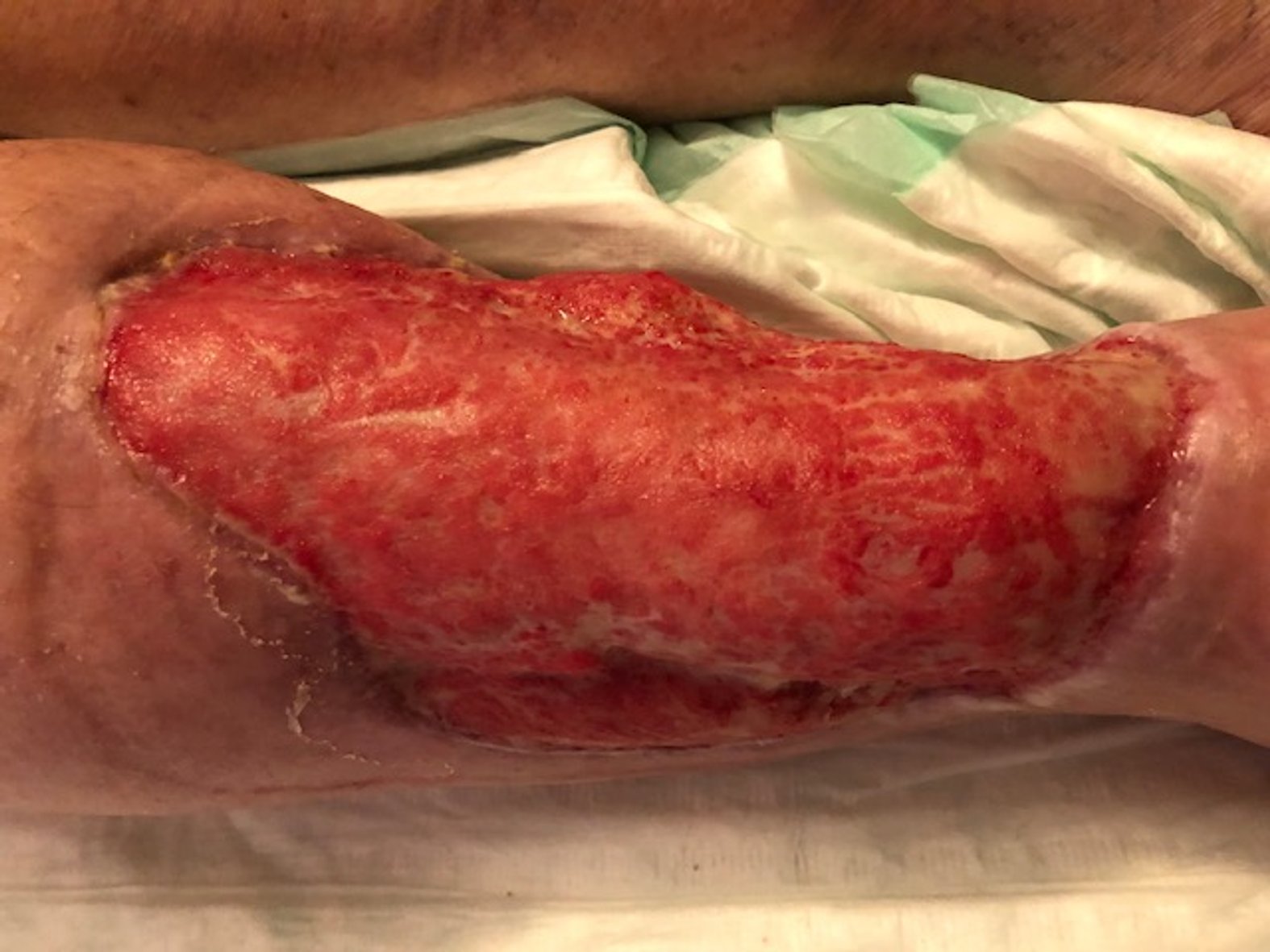 Ulcus am rechten Unterschenkel 5