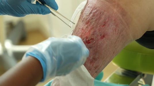 Fallbeispiel: Ulcus cruris venosum – Claudia Untermann – Trailer zum Video