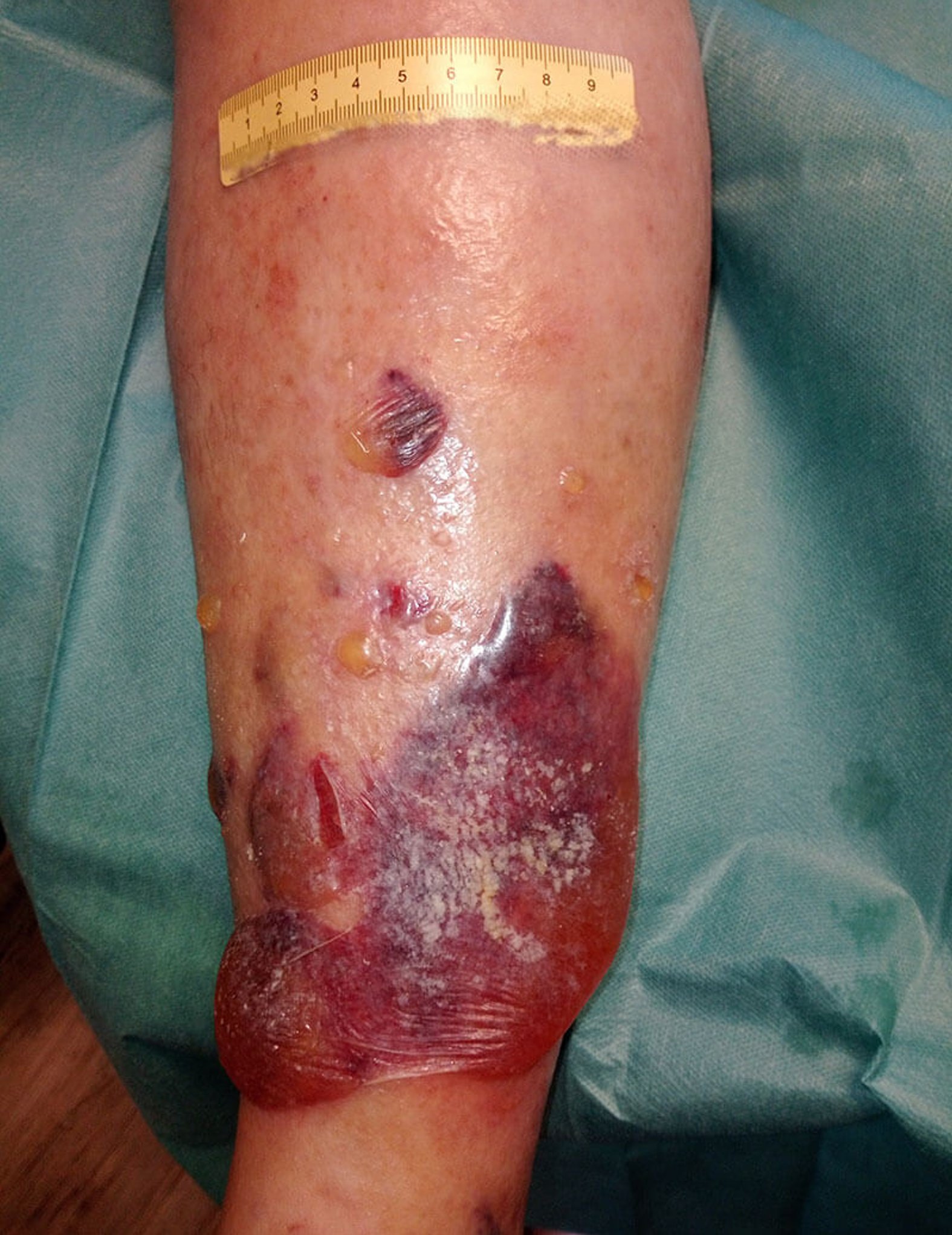 Ulcus cruris venosum nach Trauma