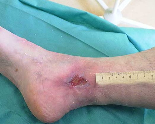Ulcus cruris arteriosum