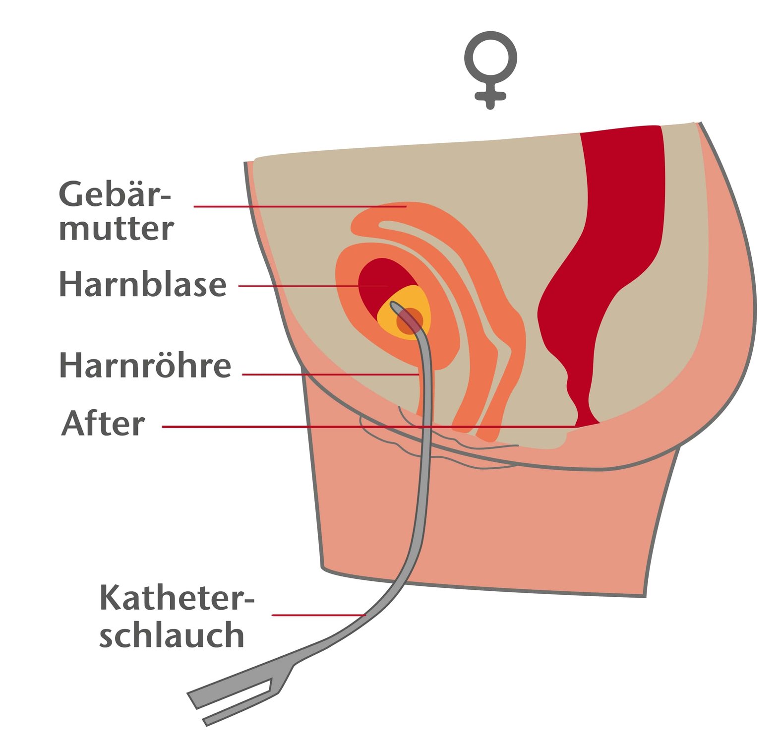 blasenkatheter-legen-frau