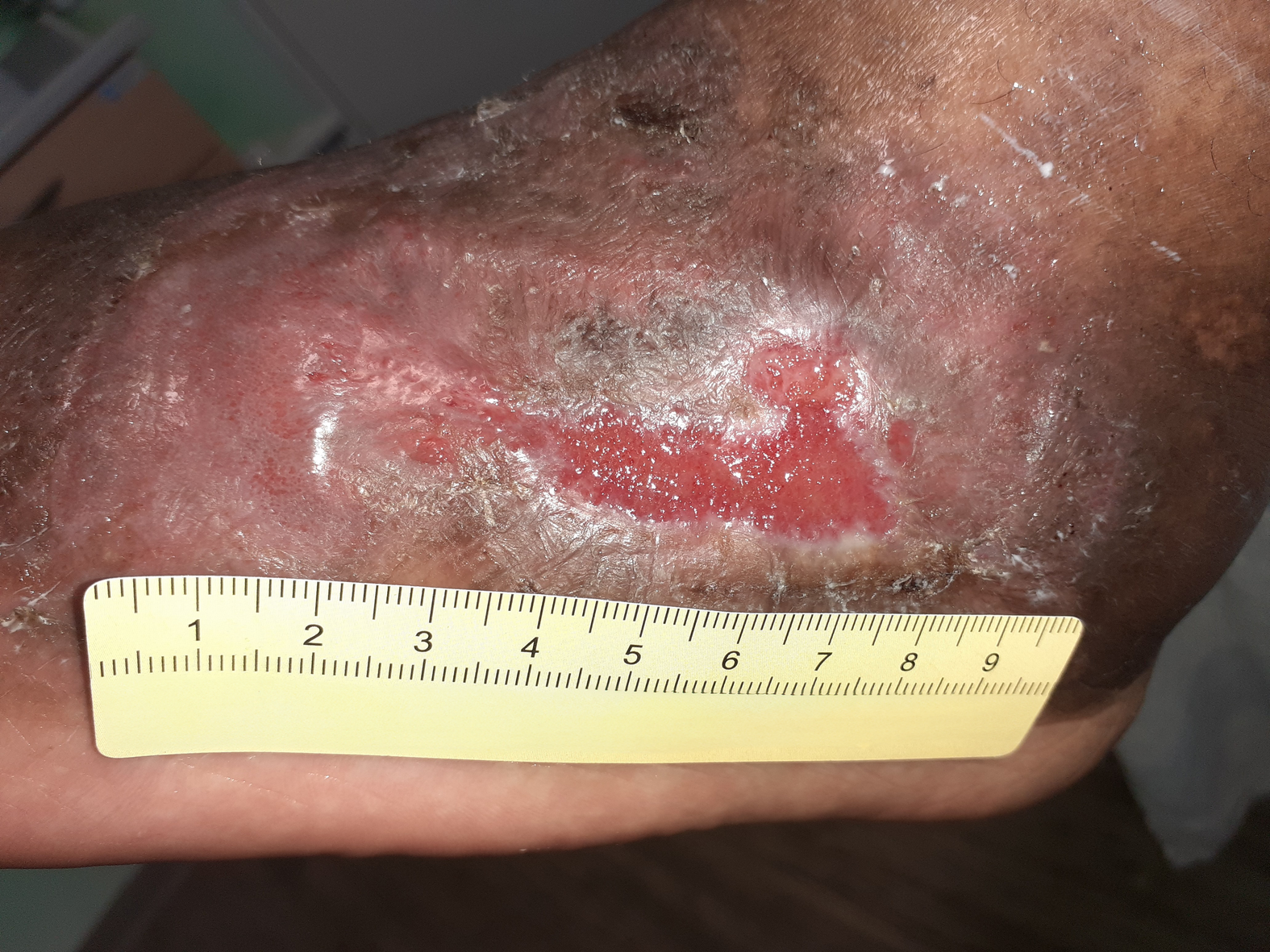 Foto 6: Wunde am linken Fuß lateral mit deutlich fortschreitender Epithelisierung (Tag 170)