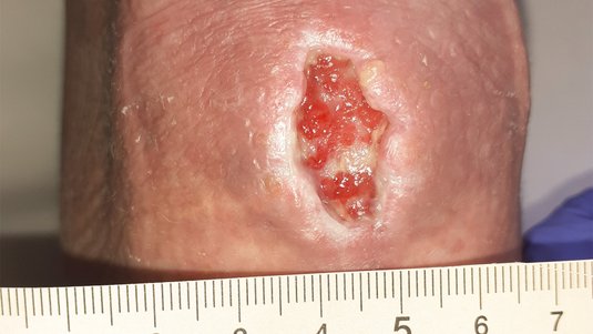 Fallbeispiel: Wundheilungsstörung am Knie