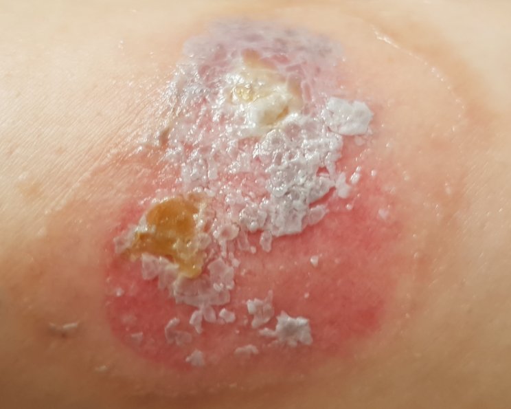 Thermische Verletzungen