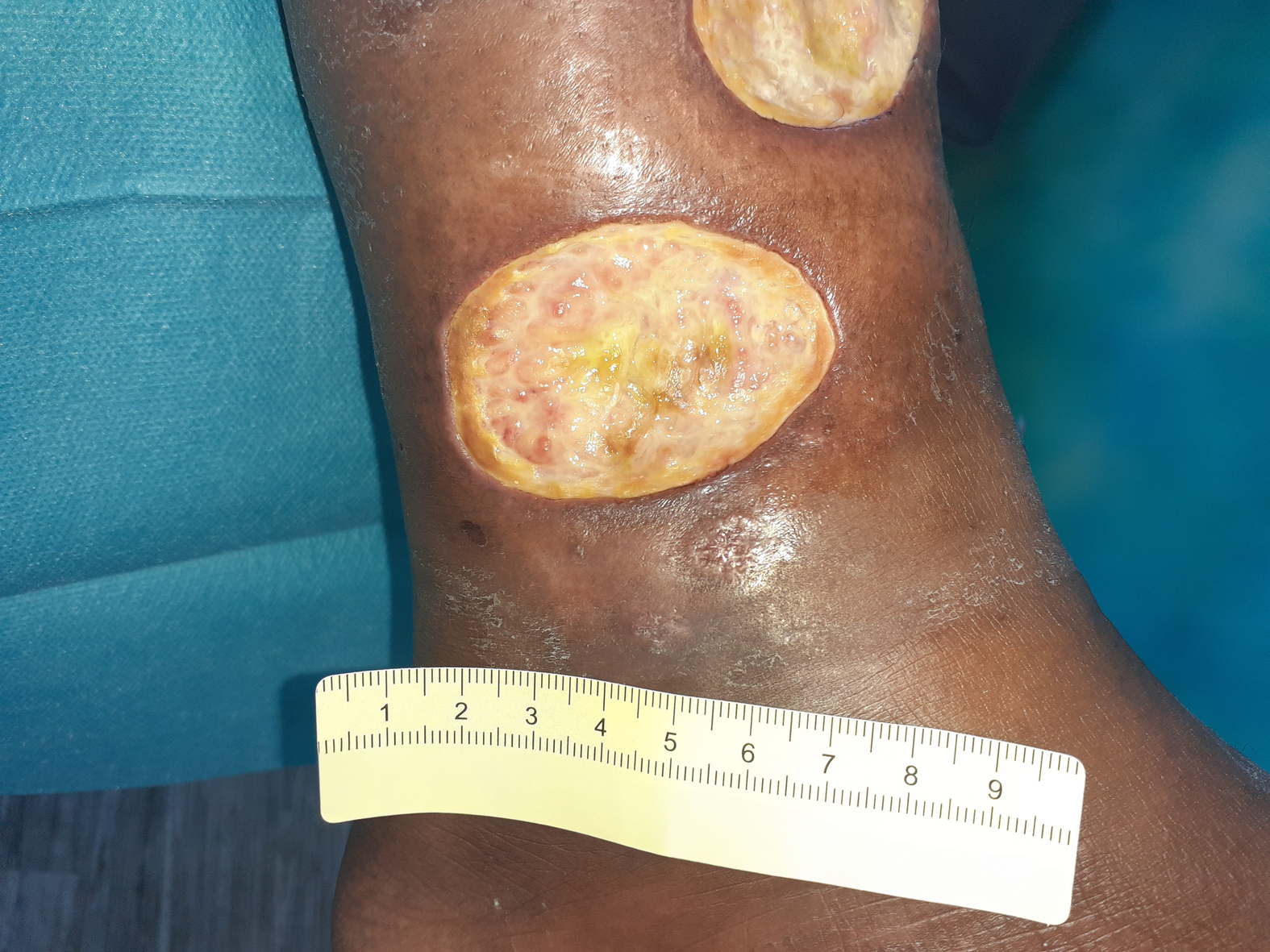 Foto 2: Ausgangssituation der Wunde am Unterschenkel medial (Tag 1)