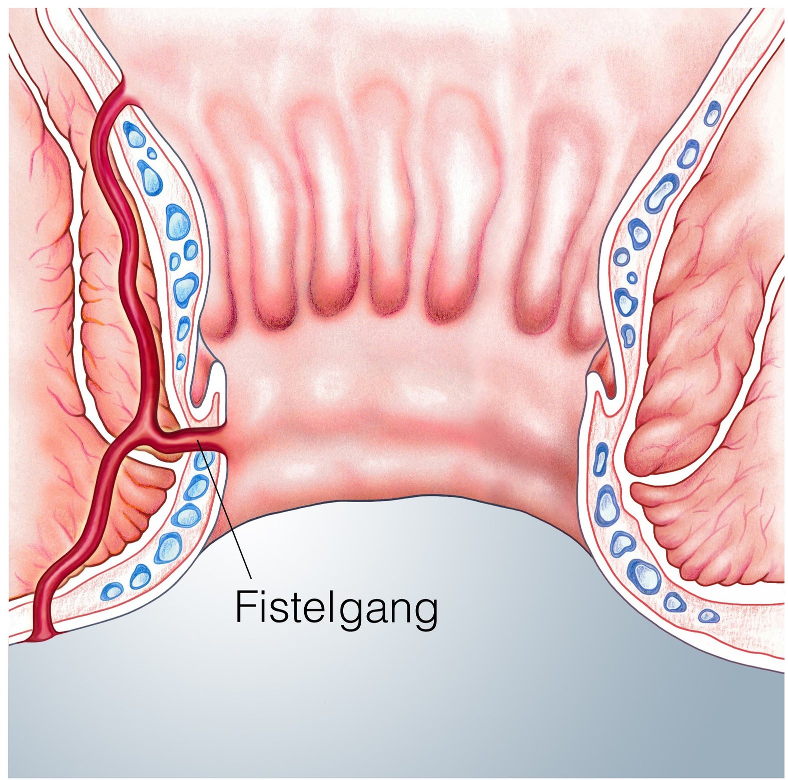 Analfistel, perianale Fistel, schematische Darstellung eines Fistelgangs
