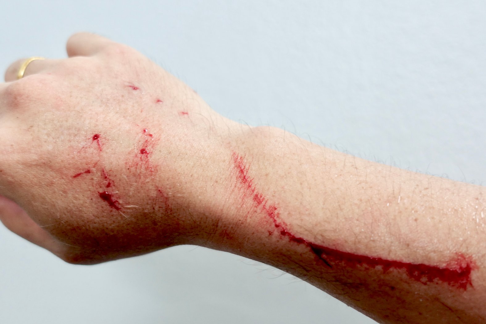 Kratzwunde durch Katze, einsetzende Blutstillungsphase