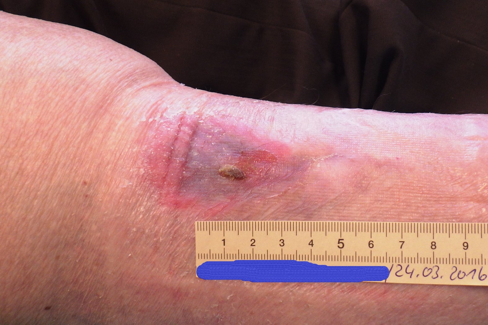 Ulcus cruris venosum, Foto 3