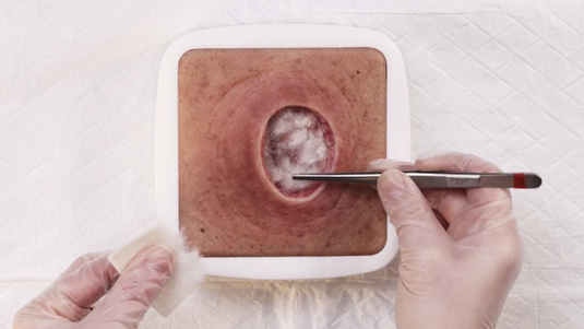 Versorgung tiefer Wunden – Alginat und Hydrofaser