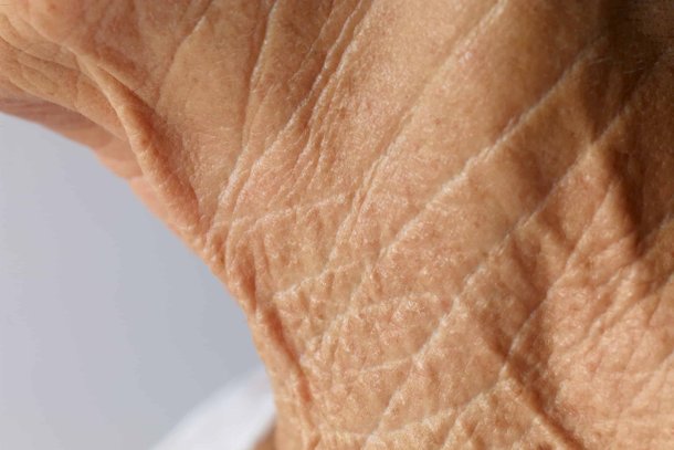 Dünne Altershaut am Hals, Falten