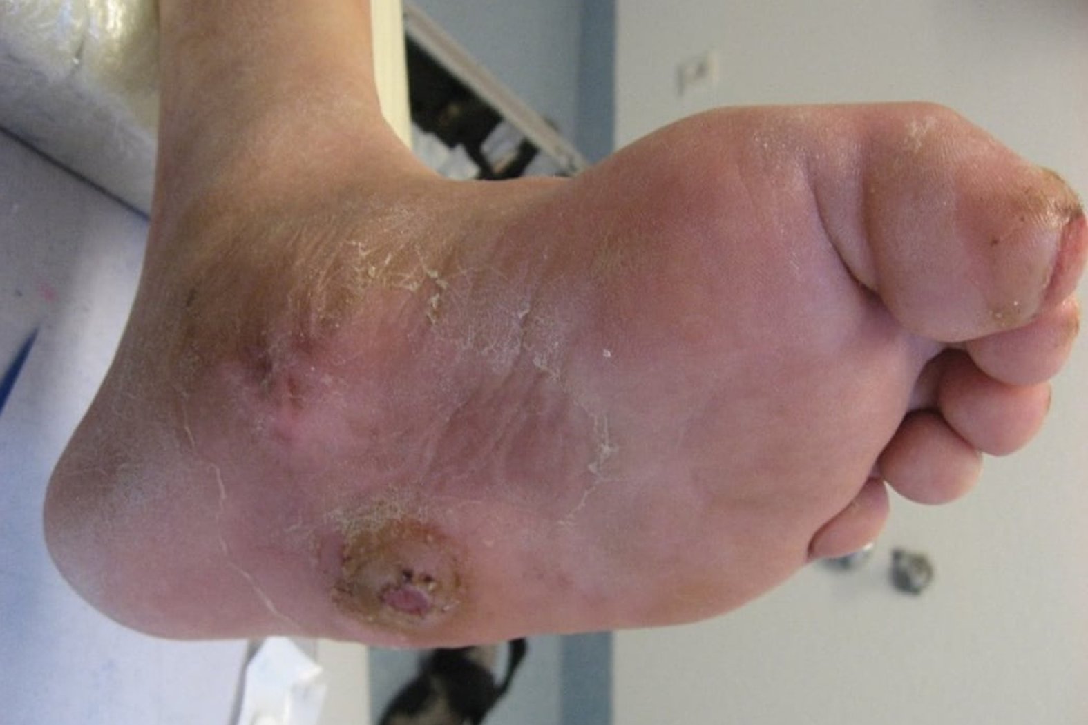 Charcot-Fußs-Ulcus mit Zehendeformation und Wunde