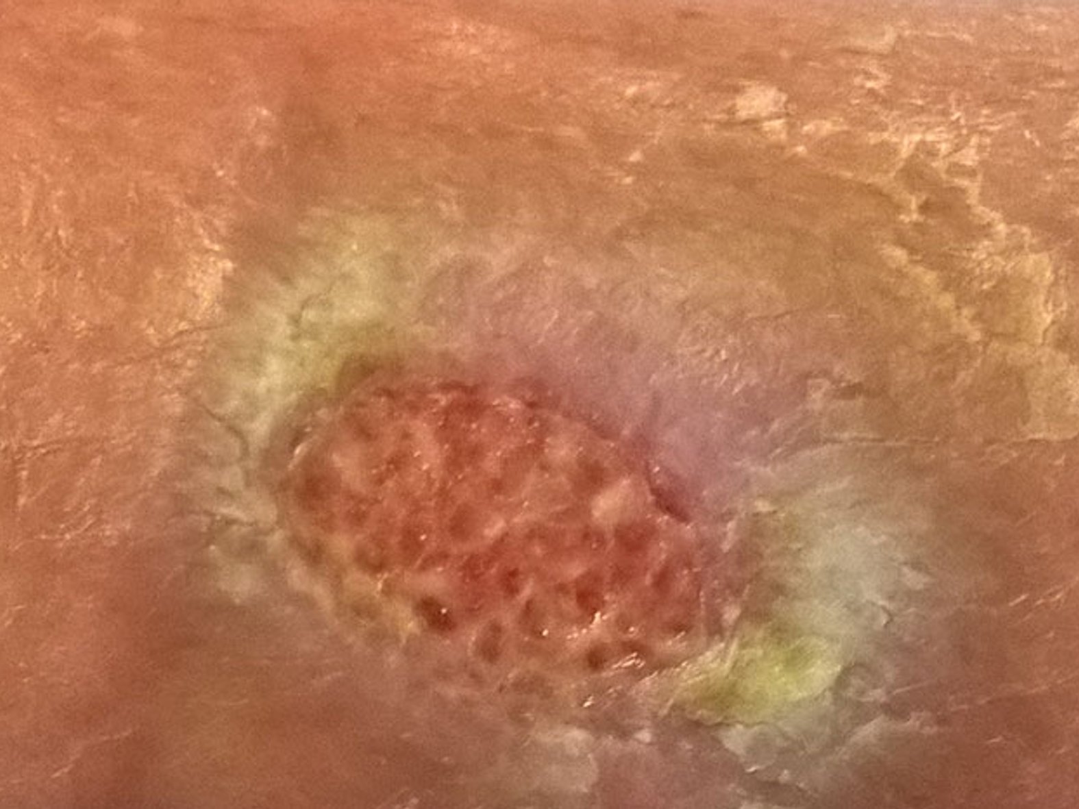 Wunde mit Fibrinbelag. rechter Unterschenkel, behandelt mit DracoFoam