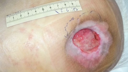 Fallbeispiel: Dekubitus am Trochanter major (Hüfte)