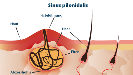 Sinus pilonidalis