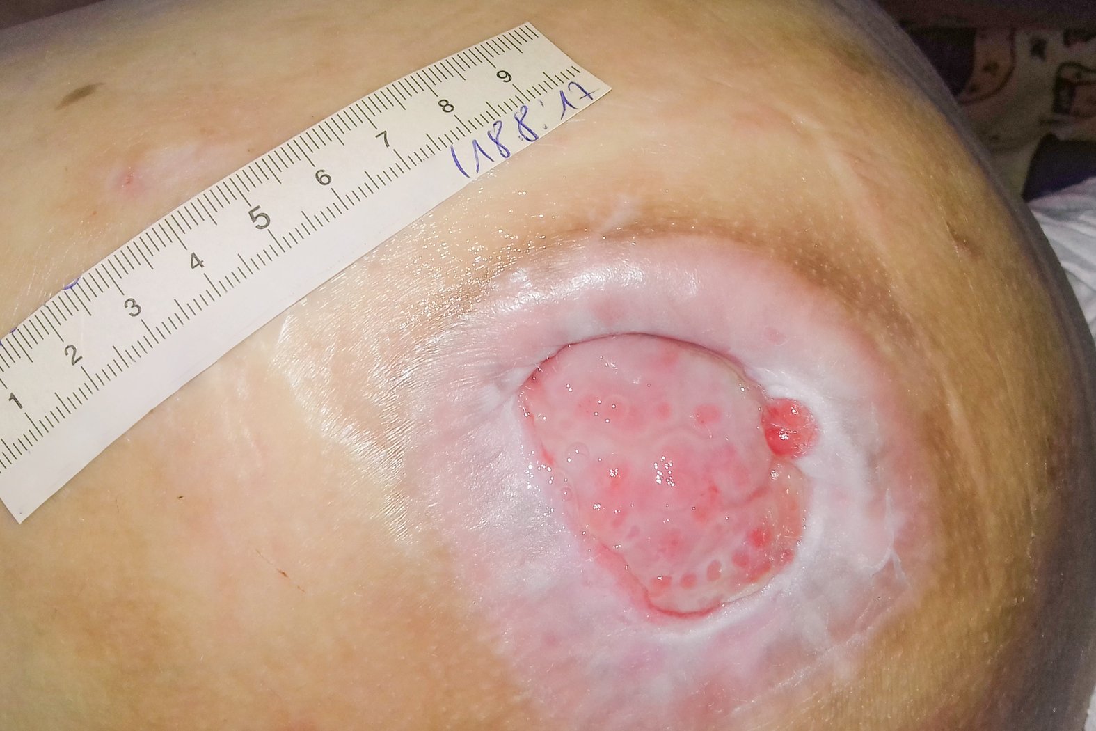 Foto 3: Verschlechterte Wundsituation mit vermehrter Mazeration und Biofilm (Tag 78)