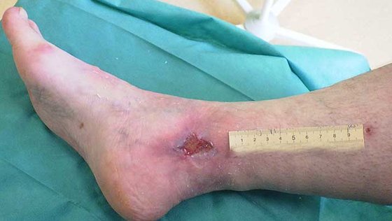 Fallbeispiel: Ulcus cruris arteriosum