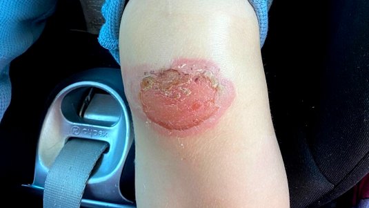 Die einfache Wunde, die nicht heilen wollte – Fallbeispiel Schürfwunde am Knie