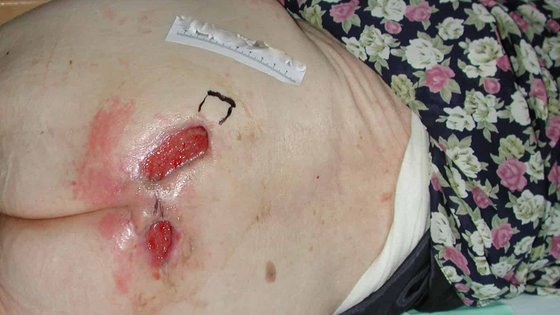 Sakraldekubitus der Kategorie 4 bei Demenzpatientin