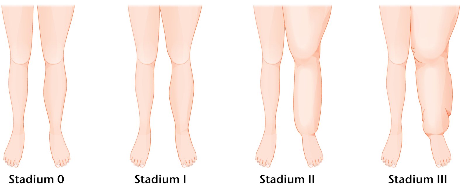 Lymphödem, Stadieneinteilung: schematische Darstellung