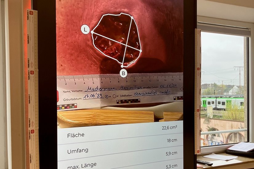Wunddoku-App mit automatischer Wundvermessung