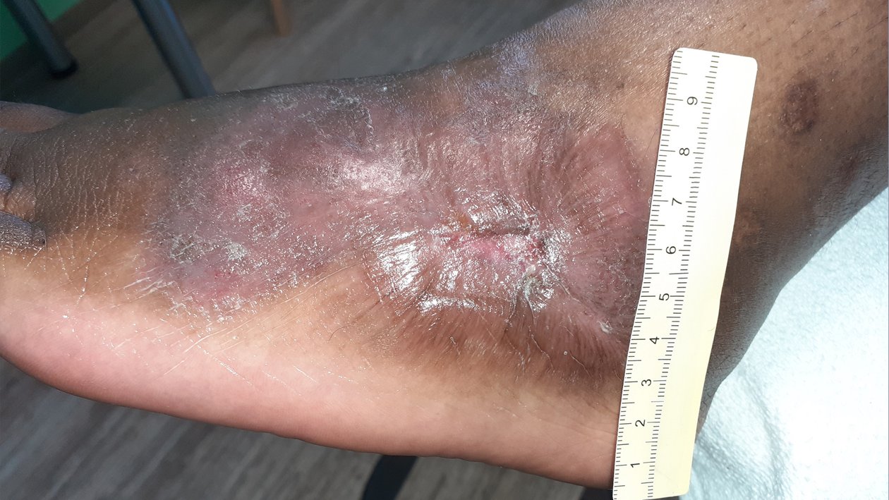 Vaskulitis, Nachher-Bild