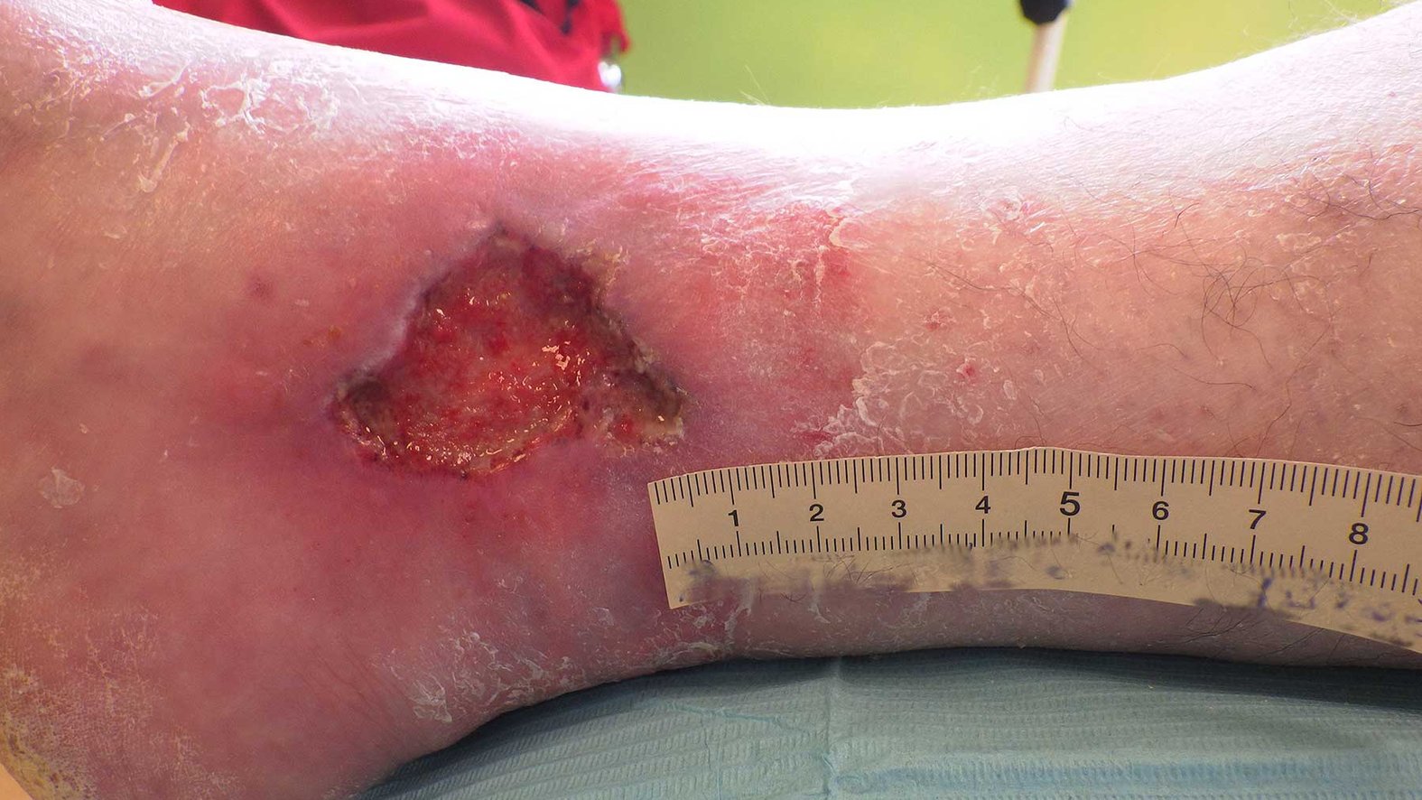 Ulcus cruris arteriosum