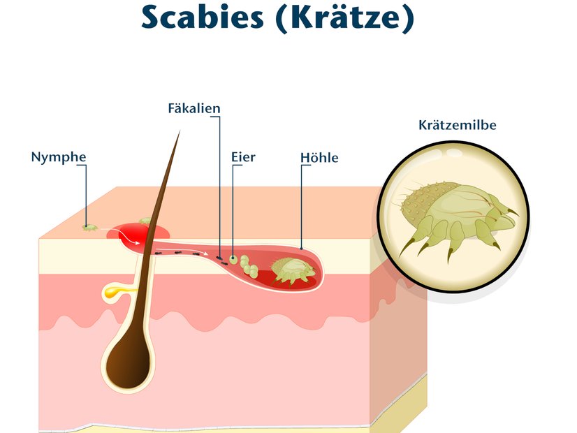 Schema: Scabies, Krätze, Krätzemilbe in der Haut