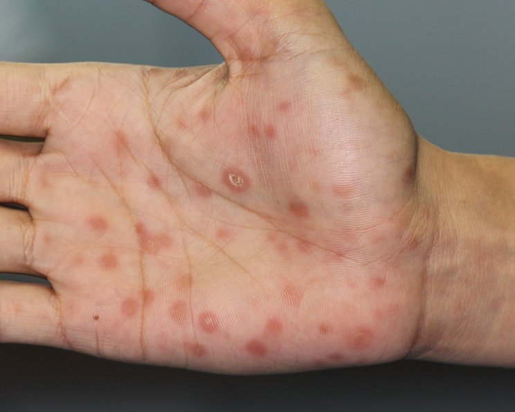 Syphillis: Diagnostik, Stadien, Wundversorgung