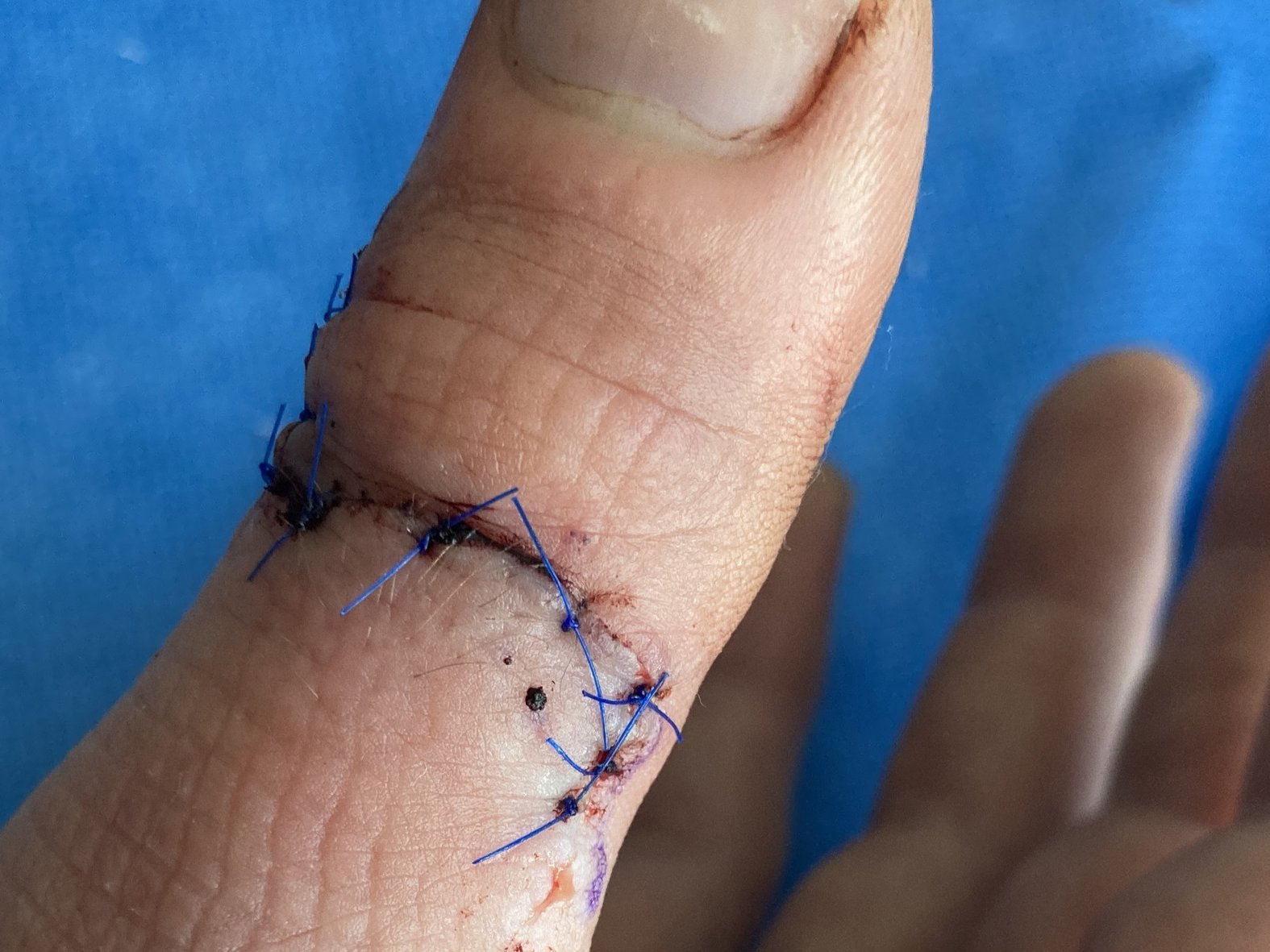 Foto 4: Die genähte Wunde am Tag nach der OP