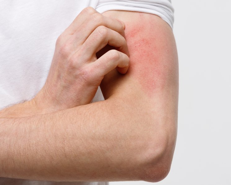 Pruritus: Ursachen, Therapie von akutem und chronischem Juckreiz