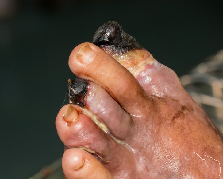 KI soll Wundversorung bei Diabetes verbessern 