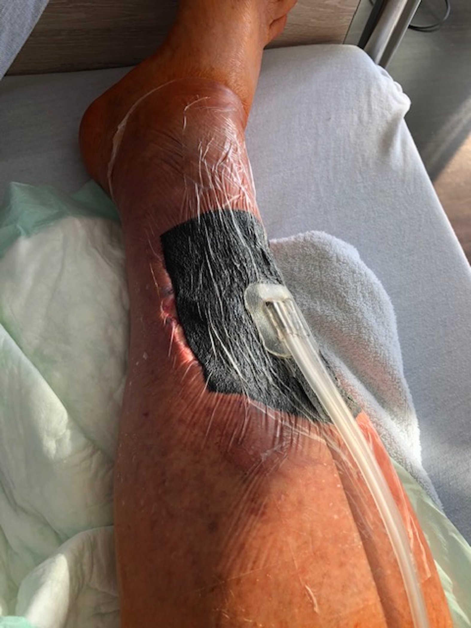 VAC-Therapie: Vakuumtherapie an Fußwunde