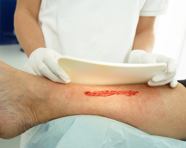 Kommentare erwünscht: Expertenstandard zur Pflege von Menschen mit chronischen Wunden