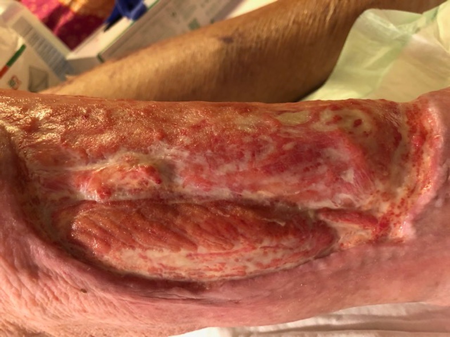 Ulcus am rechten Unterschenkel 4