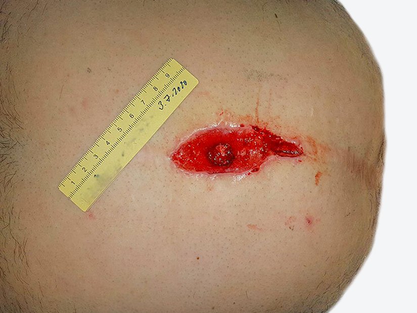 Nahtdehiszenz nach Bauch-OP