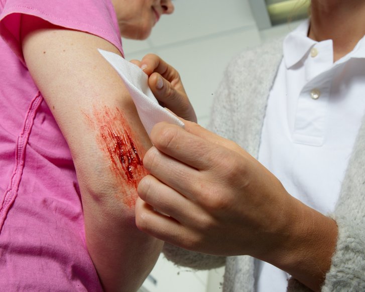 Akute Wunde: Versorgung einer offenen Wunde am Ellbogen