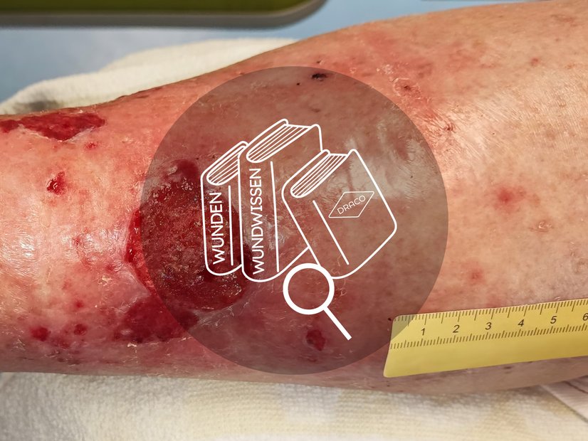 Teaser Pflegewelt Wundwissen