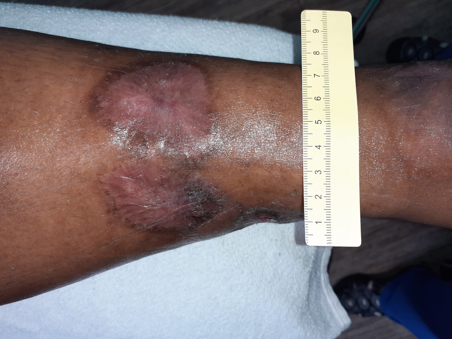 Foto 8: Abgeheilte Wunden am Unterschenkel ventral (Tag 201)