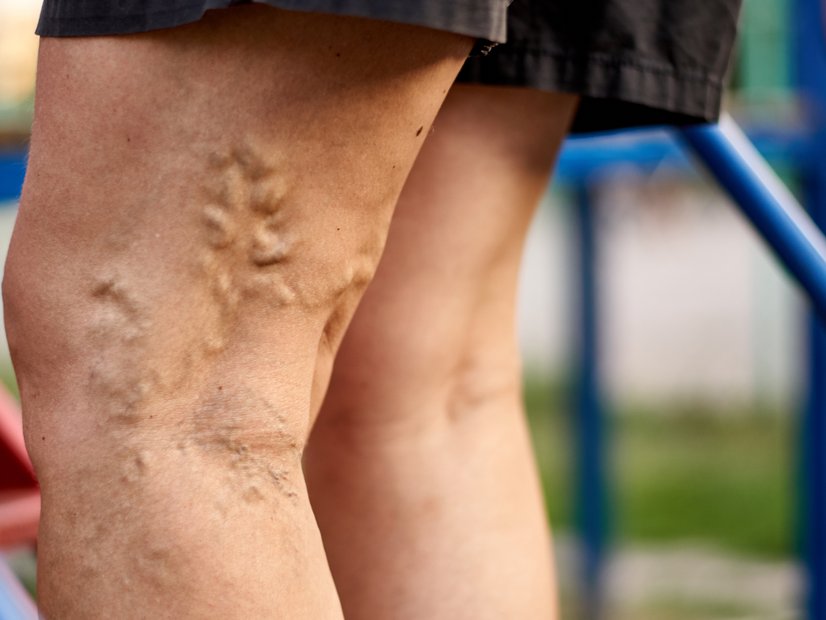 Krampfadern - Varikose am Oberschenkel