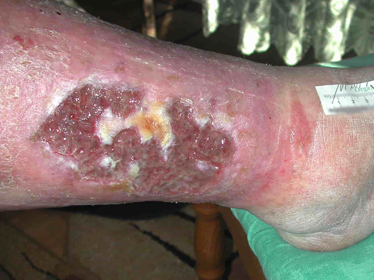 Ulcus cruris venosum Wunde