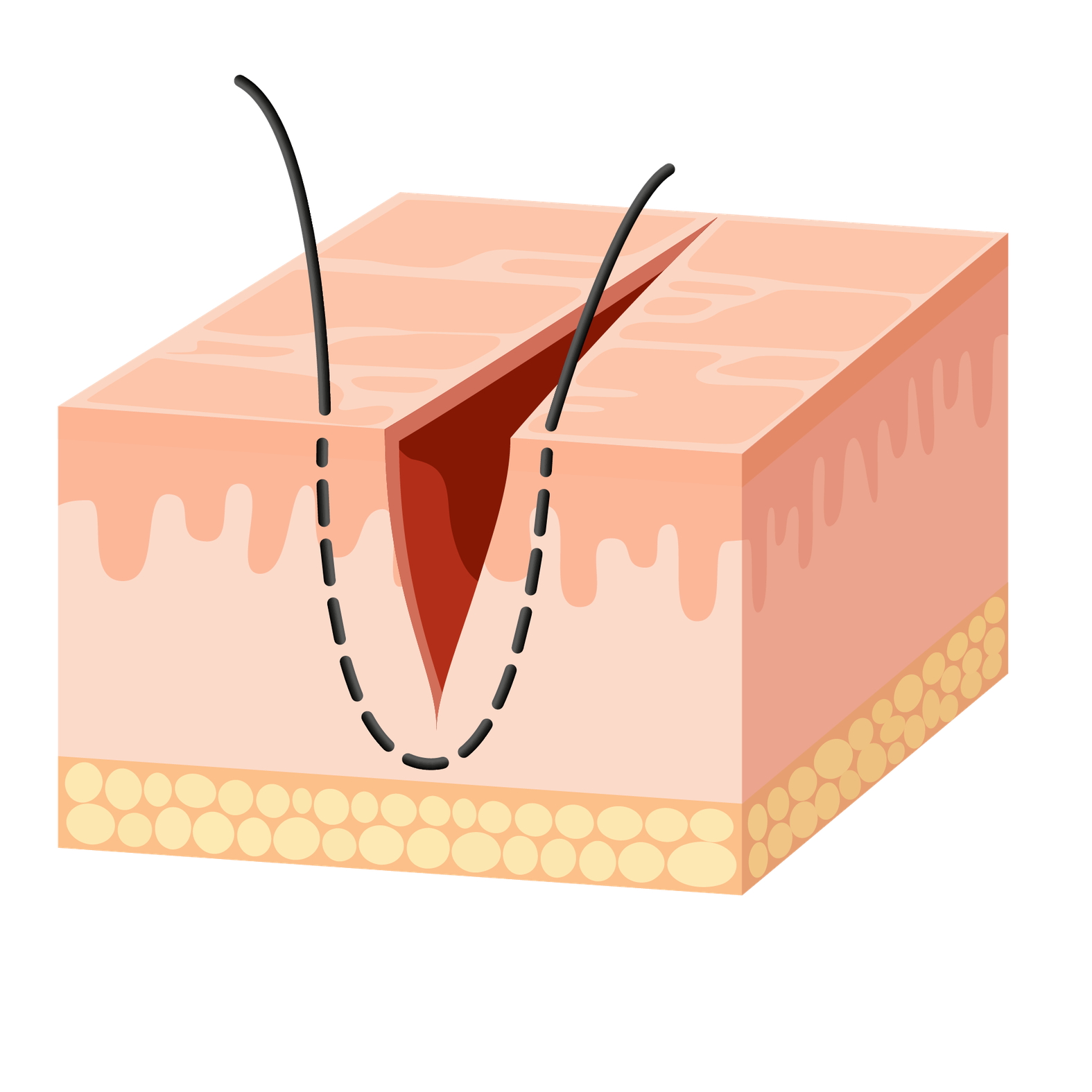 Nähen einer Wunde: Einfache Kopfnaht, Schritt 1